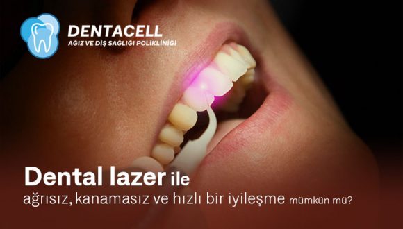 Laser dentaire
