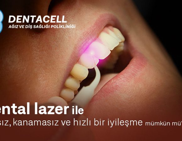 Laser dentaire