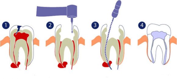 Endodontics – Canal Treatment